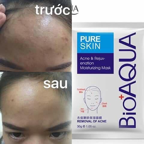 Trước và sau khi sử dụng mặt nạ trị mụn kiềm dầu Bioaqua Pure skin Acne