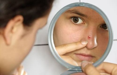 5 sai lầm khi trị mụn mủ ở mũi gây hậu quả nghiêm trọng