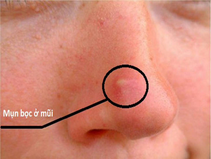 Mụn bọc ở mũi xuất hiện khiến người bị cảm thấy đau nhức, khó chịu, vncare