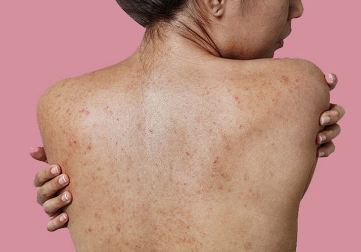 Mụn ẩn ở lưng ngực có thể là dấu hiệu của nhiều bệnh lý trong cơ thể