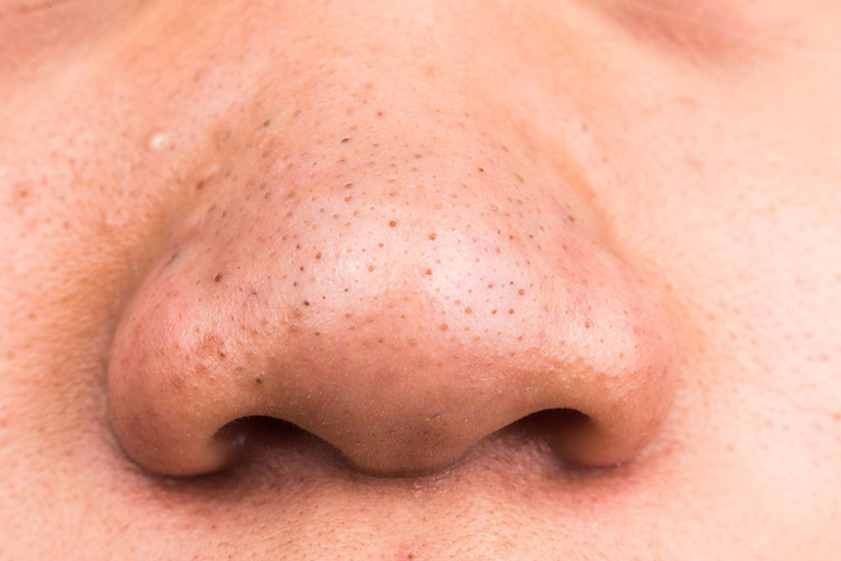 Mũi là vị trị thuộc vùng chữ T tiết nhiều bã nhờn nên dễ xuất hiện mụn ẩn dưới da