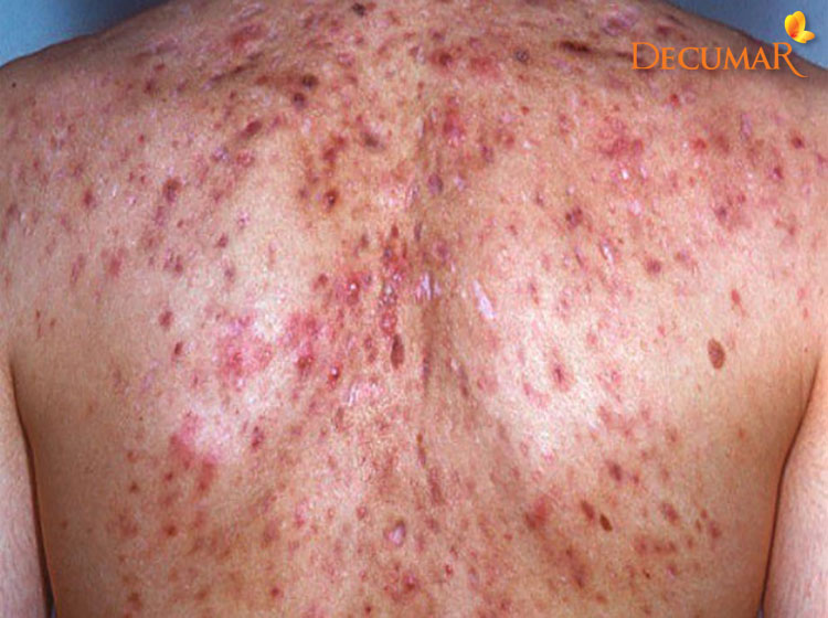 Mụn viêm ở lưng là tình trạng da đang vị viêm nhiễm khá nặng, không thể coi thường được