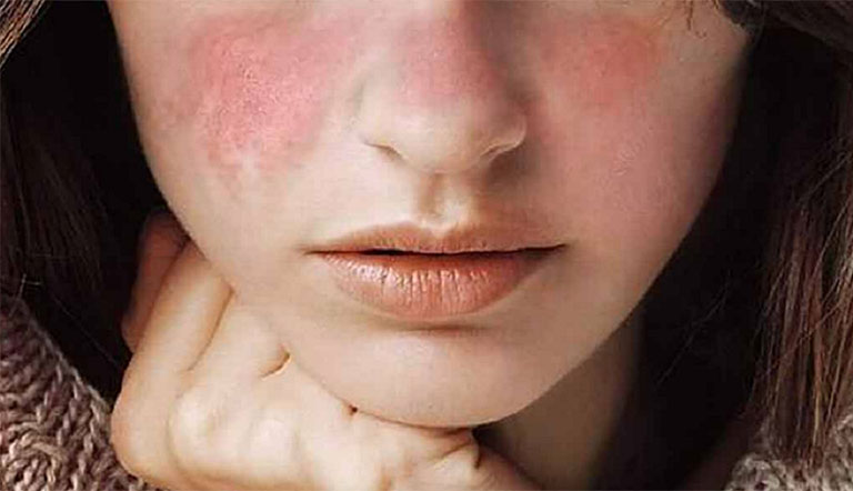 Da bị đỏ mẩn ngứa và tróc vẩy sần sùi là bị gì và cách xử lý
