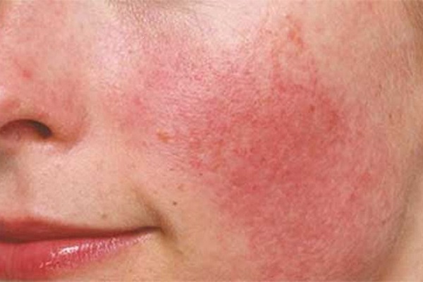 Dị ứng da mặt bao lâu thì khỏi? Giải pháp làm giảm tình trạng adapalene gel klenzit