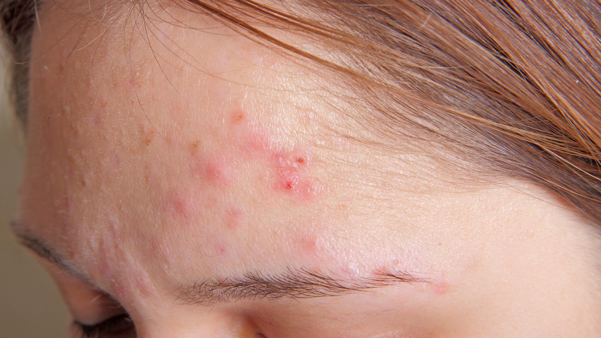 Bụi bẩn, bã nhờn không thể làm sạch bằng nước thông thường có thể gây ra những tổn thương cho da mặt.