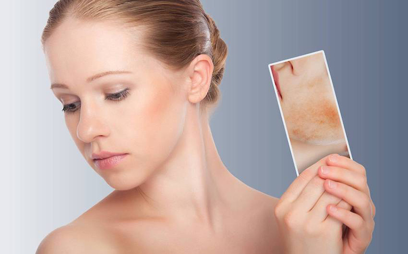 Mách cho chị em những cách chăm sóc da mặt khi bị dị ứng